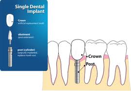 Bilde implantatkrone